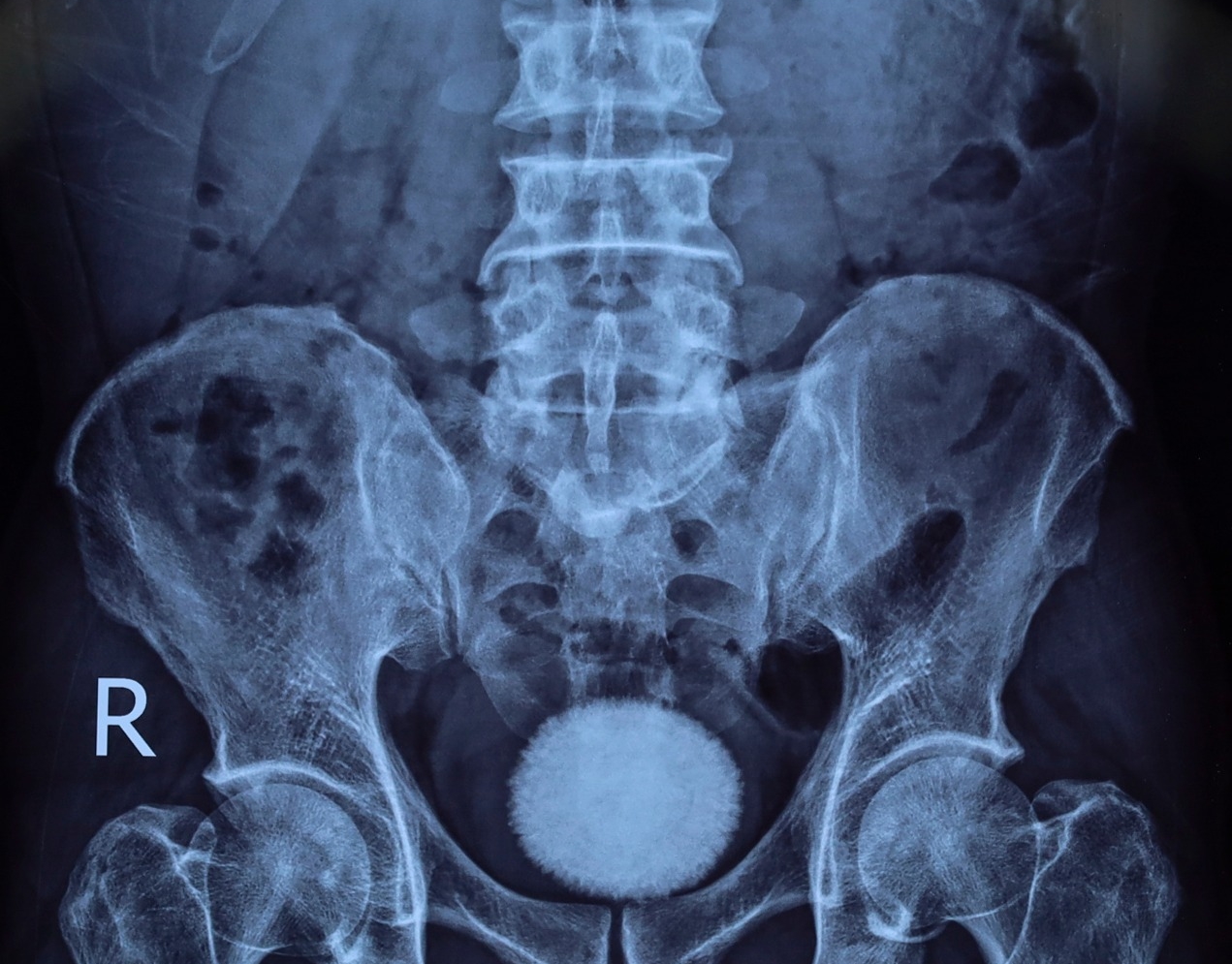 Phẫu thuật lấy viên sỏi bàng quang 'khủng' bằng quả trứng ngỗng- Ảnh 2.