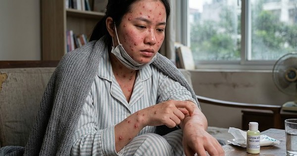 Cách điều trị bệnh thủy đậu tại nhà, ngăn ngừa sẹo