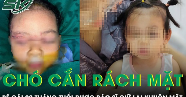 Xót xa bé gái 22 tháng tuổi bị chó cắn rách mặt