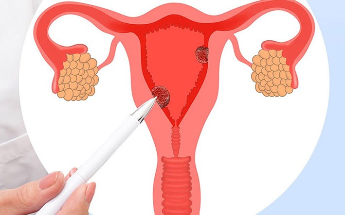 Lạc nội mạc tử cung có thể gây biến chứng gì?- Ảnh 2.