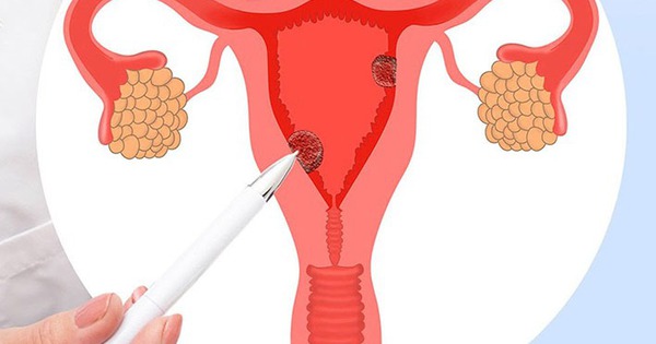 Hội chứng buồng trứng chuyển hóa đa nội tiết – tên gọi mới của hội chứng buồng trứng đa nang