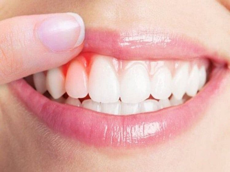 Nguyên nhân thường gặp gây chảy máu miệng và cách xử trí tại nhà- Ảnh 1. Nguyên nhân thường gặp gây chảy máu miệng và cách xử trí tại nhà- Ảnh 1.