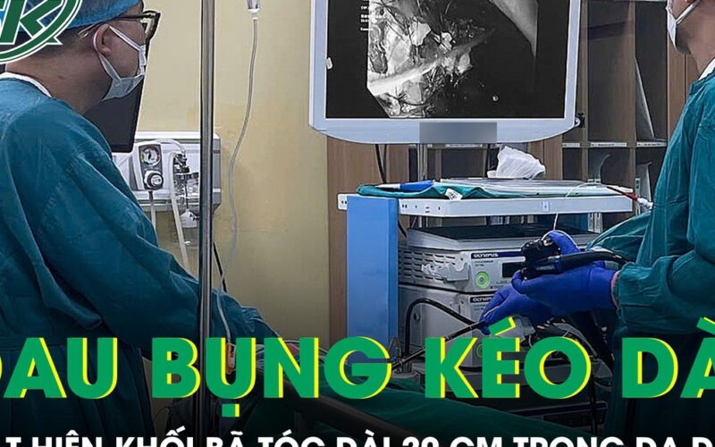 Bé gái 11 tuổi đau bụng kéo dài phát hiện khối bã tóc dài 20 cm trong dạ dày