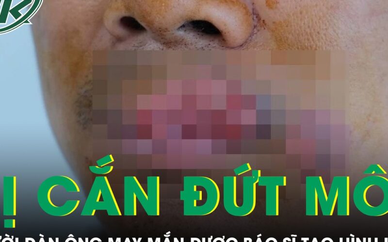 Người đàn ông bị cắn mất môi phải trải qua ca tạo hình phức tạp