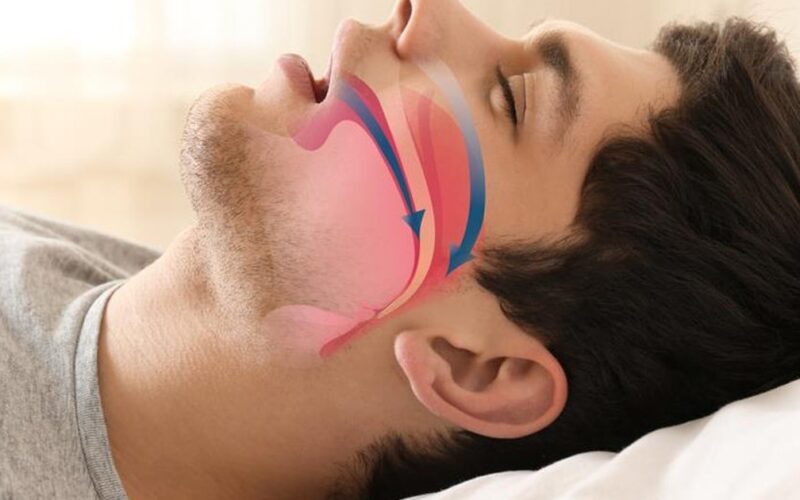Hội chứng ngưng thở khi ngủ: Biện pháp nào để điều trị hiệu quả?