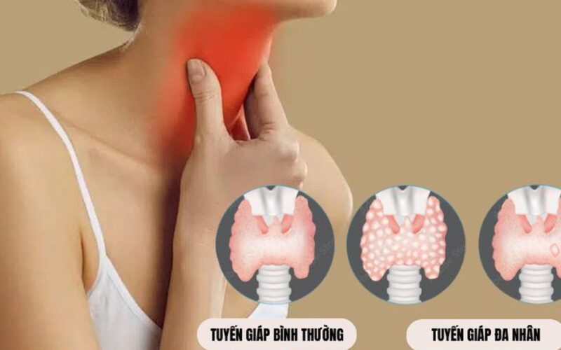 Những bệnh tuyến giáp ngày càng phổ biến trong cộng đồng