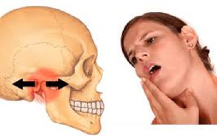 Trật khớp thái dương hàm có biểu hiện gì?