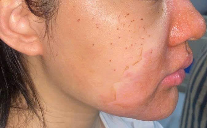 1000071148-17785492395201030458014 Peel da mặt làm đẹp, cô gái mọc chi chít mụn nước, vỡ chảy dịch- Ảnh 1.