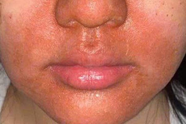 Peel da mặt làm đẹp, cô gái mọc chi chít mụn nước, vỡ chảy dịch