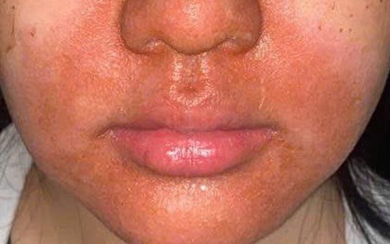 Peel da mặt làm đẹp, cô gái mọc chi chít mụn nước, vỡ chảy dịch