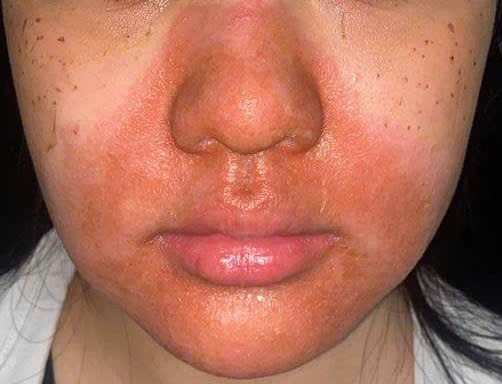 1000071152-17785507490941645632528 Peel da mặt làm đẹp, cô gái mọc chi chít mụn nước, vỡ chảy dịch- Ảnh 2.