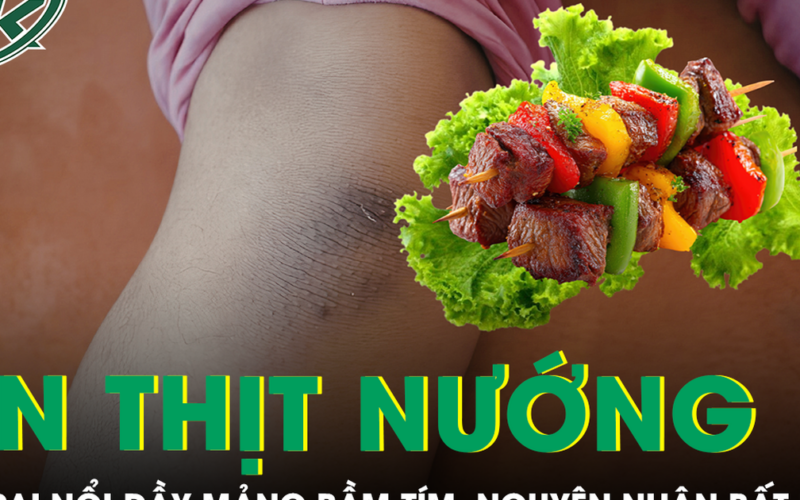 Bé trai nổi đầy mảng bầm tím sau bữa ăn thịt nướng, bác sĩ phát hiện nguyên nhân bất ngờ