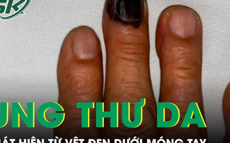 Bàng hoàng phát hiện ung thư da từ vệt đen dưới móng tay