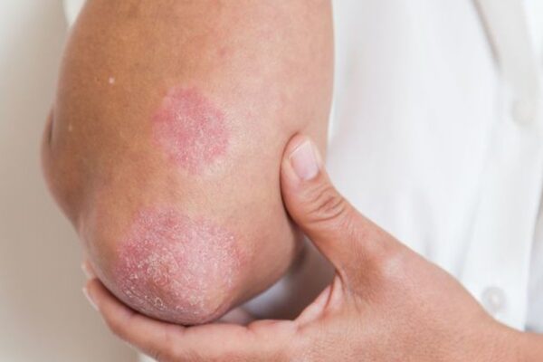 Người mắc bệnh vảy nến đối mặt áp lực tâm lý kéo dài nhiều năm