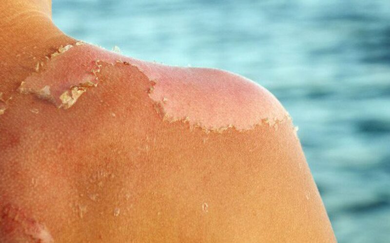 Bỏng nắng phải làm gì để tránh tổn thương da nghiêm trọng?