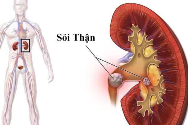 Nhập viện vì sỏi thận, chuyên gia khuyến cáo cần phát hiện sớm khi có biểu hiện này