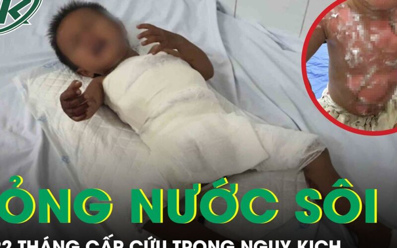 Bé 22 tháng tuổi bỏng nước sôi cấp cứu trong nguy kịch