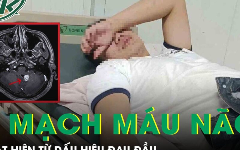 Nam thanh niên phát hiện u mạch máu não xuất huyết từ dấu hiệu đau đầu