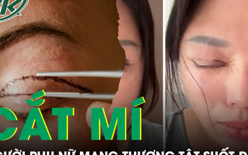 Tin lời ‘chuyên gia’ thẩm mỹ, người phụ nữ nhận kết cục đau đớn sau cắt mí mắt