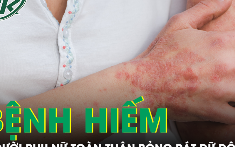 Căn bệnh hiếm khiến người phụ nữ sốt cao, toàn thân đỏ rực và bỏng rát dữ dội