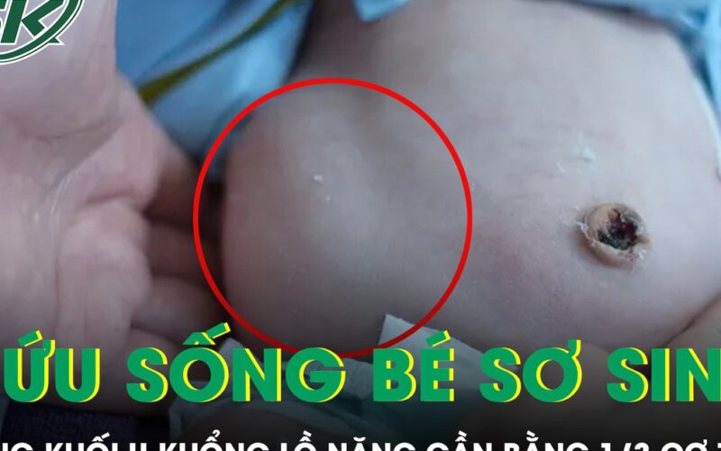 Cứu sống bé sơ sinh mang khối u khổng lồ nặng gần bằng 1/3 cơ thể
