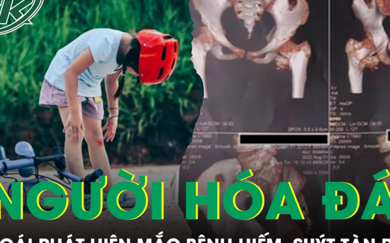 Bé gái cứng khớp suốt 2 năm sau cú ngã nhẹ, bác sĩ phát hiện mắc bệnh ‘người hóa đá’
