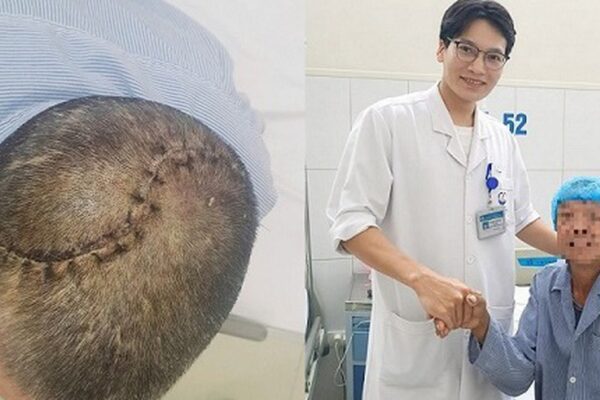 90 phút ‘nghẹt thở’ cứu người đàn ông bị vỡ lún sọ, tràn máu màng phổi
