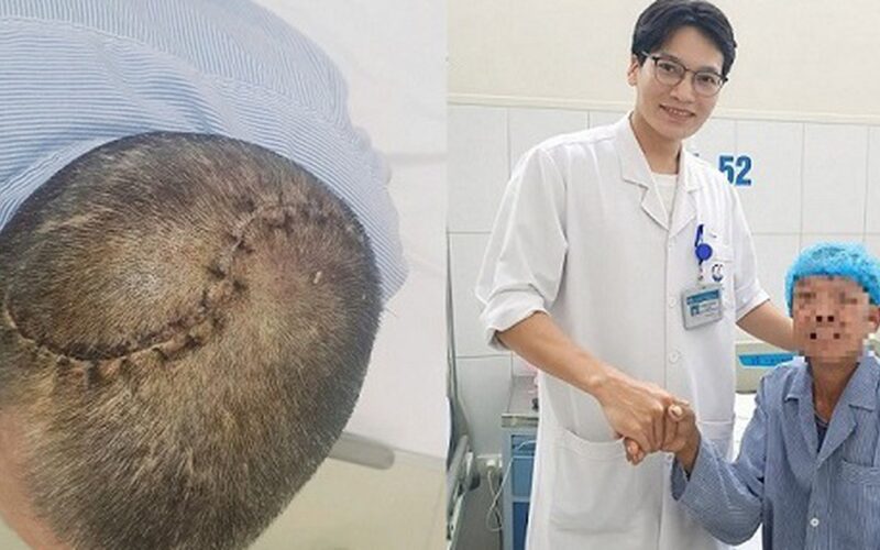 90 phút ‘nghẹt thở’ cứu người đàn ông bị vỡ lún sọ, tràn máu màng phổi