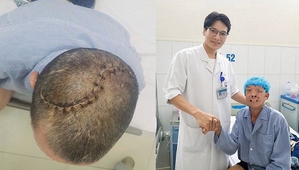 90 phút 'nghẹt thở' cứu người đàn ông bị vỡ lún sọ, tràn máu màng phổi- Ảnh 1.