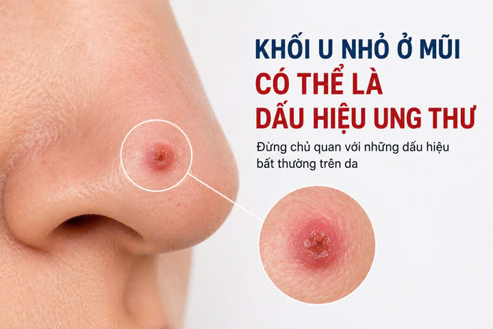 Cảnh báo ung thư da núp bóng những tổn thương tưởng chừng vô hại- Ảnh 1.