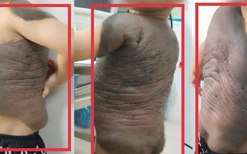 6 lần đại phẫu cắt bỏ khối u ‘mai rùa’ nặng trĩu trên lưng bé trai 7 tuổi