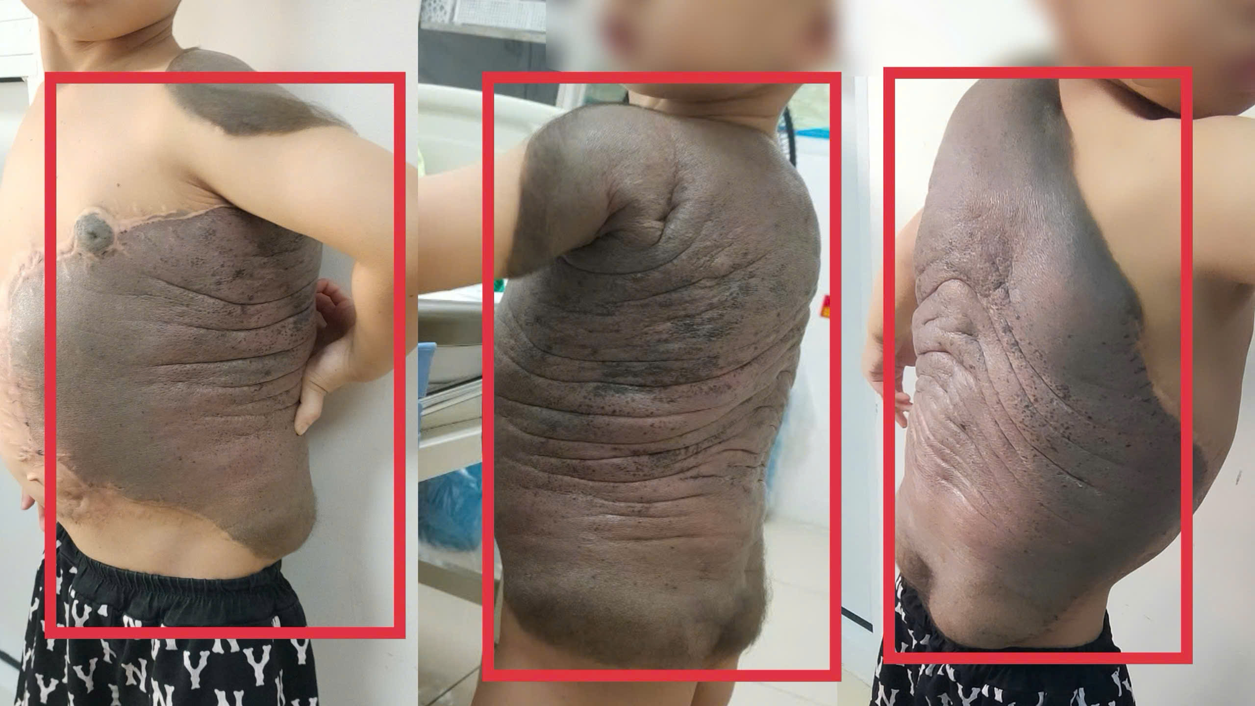 Hành trình phẫu thuật khối u hắc tố tại bệnh viện: Câu chuyện cảm động của bé trai 7 tuổi - Ảnh 2.