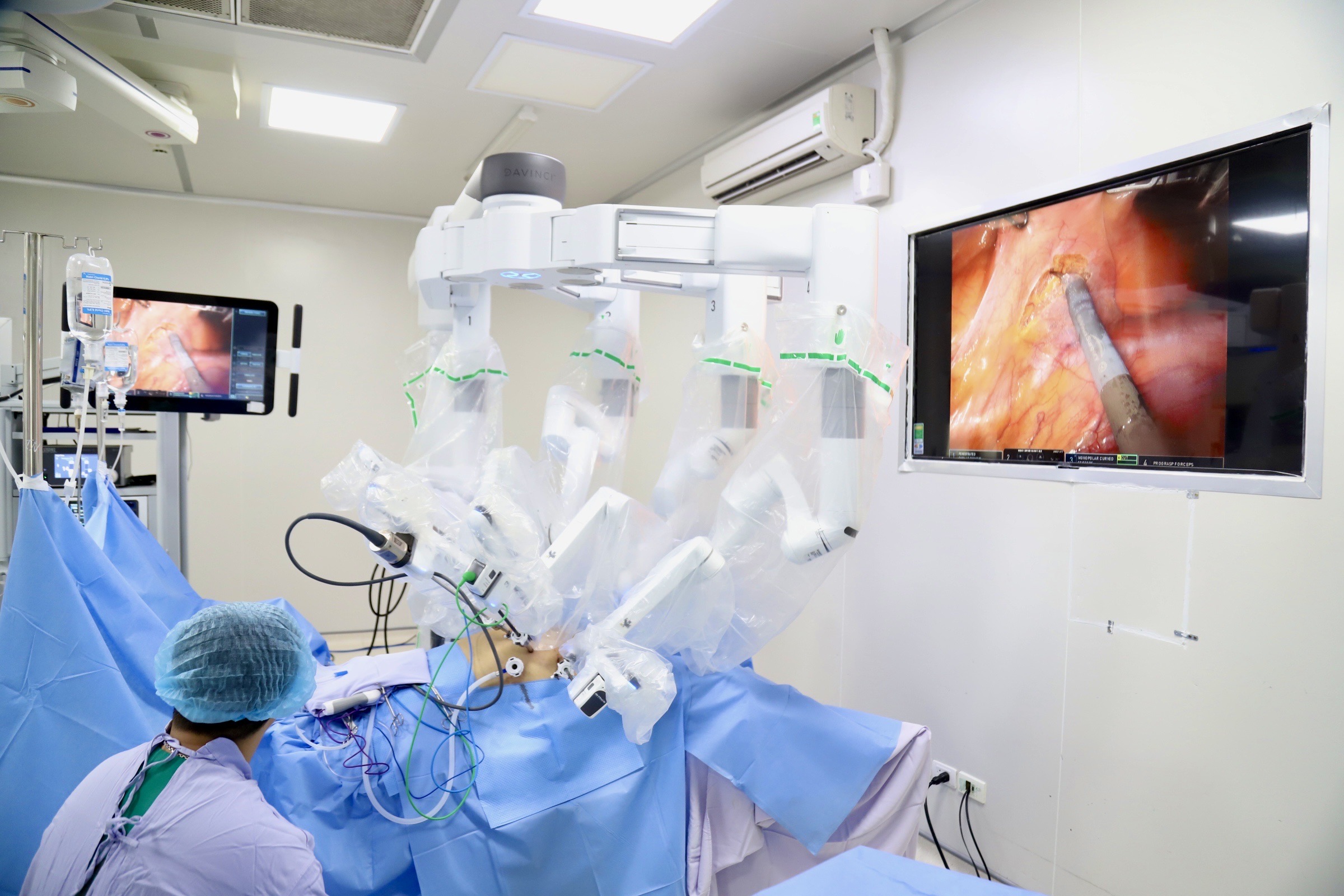 Chủ quan với dấu hiệu đi ngoài ra máu, người đàn ông 42 tuổi 'sốc' vì ung thư trực tràng- Ảnh 2.