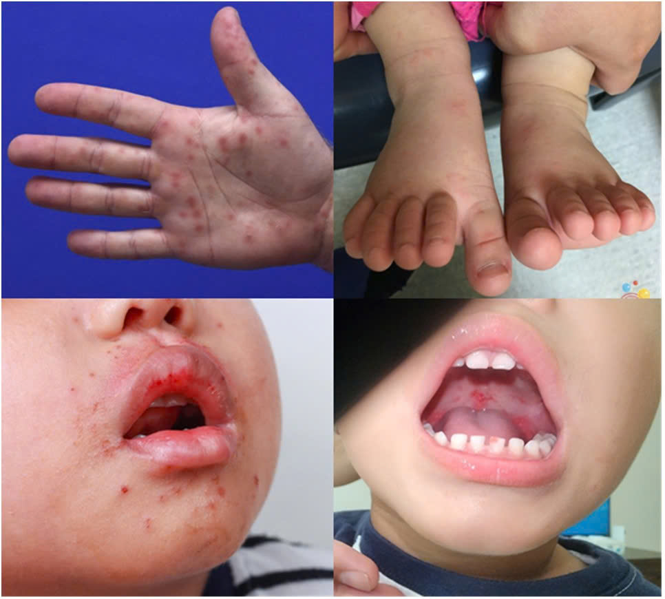 TPHCM: Tay chân miệng gia tăng, 'tấn công' trẻ lớn - Ảnh 2.