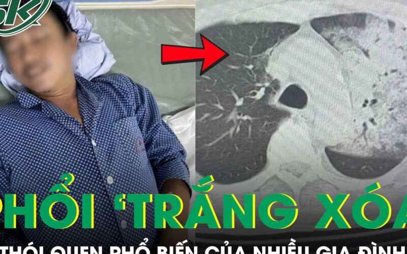 Tưởng cảm cúm, người đàn ông bất ngờ suy đa tạng, phổi ‘trắng xoá’ vì thói quen nhiều người mắc